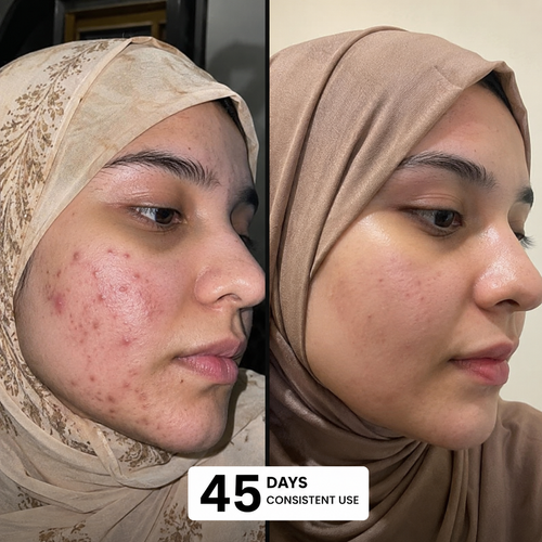 Neem Acne Fix Soap